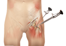 Hip Arthroscopy