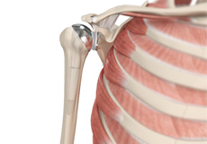 Shoulder Joint Replacement