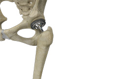 Total Hip Replacement