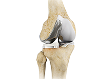 Unicompartmental Knee Replacement